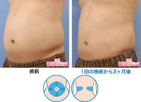 クールスカルプティング 症例写真13 土屋さん(腹部4＋腰2エリア）1回の施術から3ヶ月後