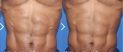 トゥルースカルプFlex 腹部 8週間から12週間後 症例写真