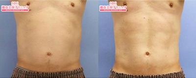 トゥルースカルプID 腹部 1ヵ月後 症例写真