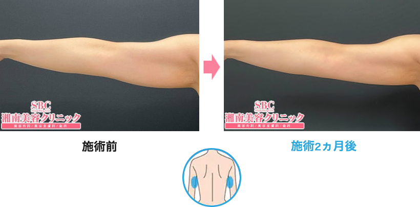 メディカルサイズダウン　二の腕の部分痩せ・集中痩せ　ピックアップ症例写真
