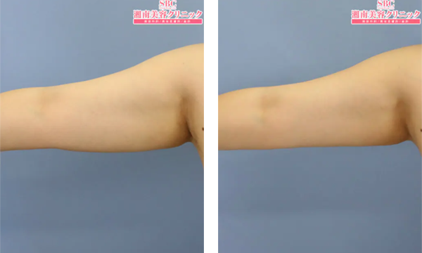 クールスカルプティング（クルスカ）の二の腕の症例写真